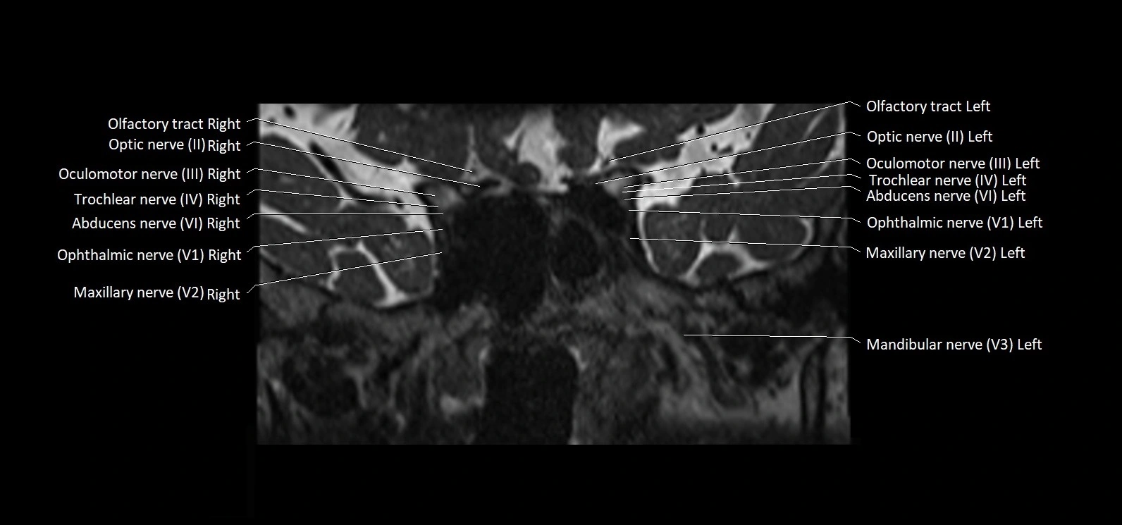 Cranial nerve cross sectional anatomy coronal 3T MRI image 22.webp